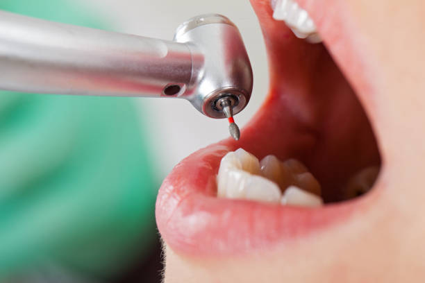 Emergency Dental Filling Replacement in NE